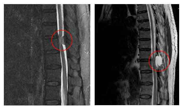 Tumors of Spine-Spinal cancer-Cause-Diagnoses-Best Treatment-Best Homeopathic oncologist-Pakistan-Dr Qaisar Ahmed-Dixe-Cosmetic